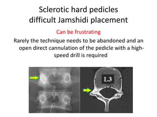 Sclerotic hard pedicles
difficult Jamshidi placement
Can be frustrating
Rarely the technique needs to be abandoned and an
open direct cannulation of the pedicle with a high-
speed drill is required
 