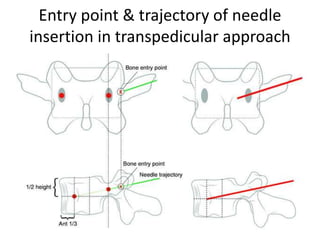Entry point & trajectory of needle
insertion in transpedicular approach
 