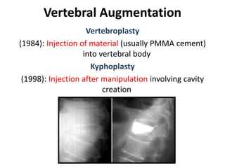Vertebral Augmentation
Vertebroplasty
(1984): Injection of material (usually PMMA cement)
into vertebral body
Kyphoplasty
(1998): Injection after manipulation involving cavity
creation
 