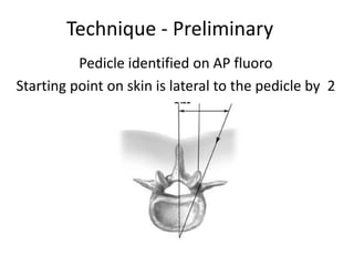 Technique - Preliminary
Pedicle identified on AP fluoro
Starting point on skin is lateral to the pedicle by 2
cm
 