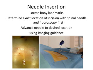Needle Insertion
Locate bony landmarks
Determine exact location of incision with spinal needle
and fluoroscopy first
Advance needle to desired location
using imaging guidance
 