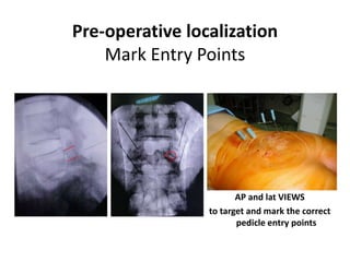 Pre-operative localization
Mark Entry Points
AP and lat VIEWS
to target and mark the correct
pedicle entry points
 