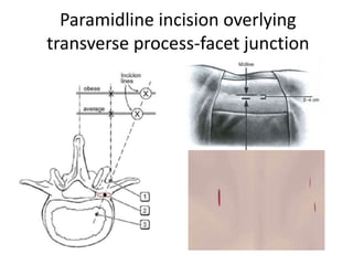 Paramidline incision overlying
transverse process-facet junction
 
