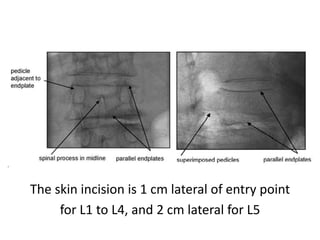 The skin incision is 1 cm lateral of entry point
for L1 to L4, and 2 cm lateral for L5
 