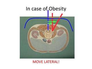 In case of Obesity
MOVE LATERAL!
 