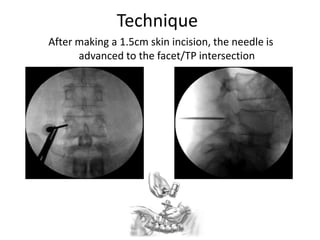 Technique
After making a 1.5cm skin incision, the needle is
advanced to the facet/TP intersection
AP Fluoroscopy is KEY
to safe pedicle
navigation. The critical
aspect relates to staying
lateral to the medial
wall. AP Fluoro is the
only view that gives
that information. A
good AP will also give
some sagital plane
information
 