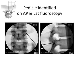 Pedicle identified
on AP & Lat fluoroscopy
 