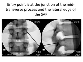 Entry point is at the junction of the mid-
transverse process and the lateral edge of
the SAF
 