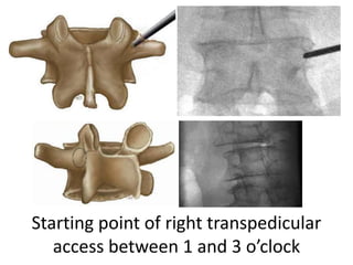 Starting point of right transpedicular
access between 1 and 3 o’clock
 
