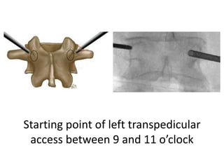 Starting point of left transpedicular
access between 9 and 11 o’clock
 