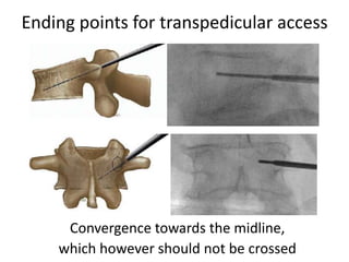 Ending points for transpedicular access
Convergence towards the midline,
which however should not be crossed
 