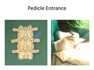 Pedicle Entrance
 