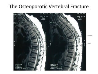 The Osteoporotic Vertebral Fracture
 