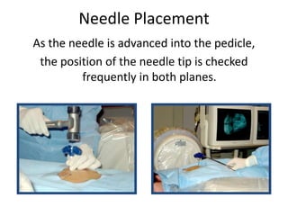 Needle Placement
As the needle is advanced into the pedicle,
the position of the needle tip is checked
frequently in both planes.
 