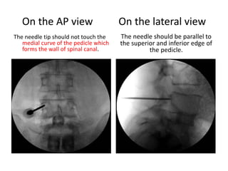 On the AP view On the lateral view
The needle tip should not touch the
medial curve of the pedicle which
forms the wall of spinal canal.
The needle should be parallel to
the superior and inferior edge of
the pedicle.
 