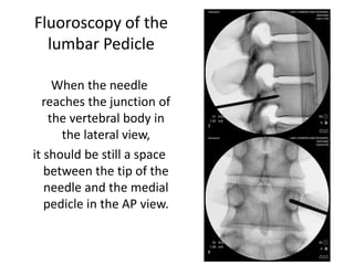 Fluoroscopy of the
lumbar Pedicle
When the needle
reaches the junction of
the vertebral body in
the lateral view,
it should be still a space
between the tip of the
needle and the medial
pedicle in the AP view.
 