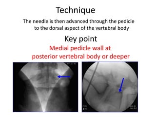 Technique
The needle is then advanced through the pedicle
to the dorsal aspect of the vertebral body
The intersection of the
pedicle and vertebral
body is the critical
junction. If the needle is
not medial to the medial
wall when the needle is
at this depth, then a safe
trajectory has been
found.
Key point
Medial pedicle wall at
posterior vertebral body or deeper
 