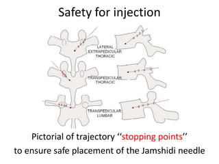 Safety for injection
Pictorial of trajectory ‘‘stopping points’’
to ensure safe placement of the Jamshidi needle
 