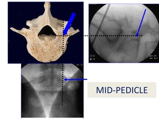 MID-PEDICLE
 
