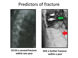 Predictors of fracture
19.2% a second fracture
within one year
24% a further fracture
within a year
 