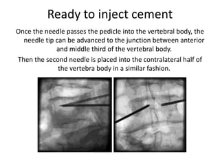Ready to inject cement
Once the needle passes the pedicle into the vertebral body, the
needle tip can be advanced to the junction between anterior
and middle third of the vertebral body.
Then the second needle is placed into the contralateral half of
the vertebra body in a similar fashion.
 