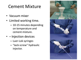 Cement Mixture
• Vacuum mixer
• Limited working time.
– 10-15 minutes depending
on temperature and
cement mixture.
• – Injection devices
– Luer-Lok syringes
– “Jack-screw” hydraulic
injector.
 
