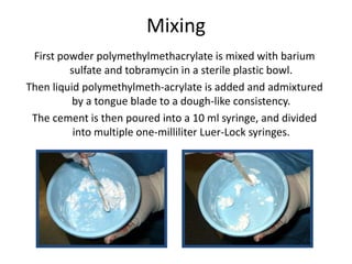 Mixing
First powder polymethylmethacrylate is mixed with barium
sulfate and tobramycin in a sterile plastic bowl.
Then liquid polymethylmeth-acrylate is added and admixtured
by a tongue blade to a dough-like consistency.
The cement is then poured into a 10 ml syringe, and divided
into multiple one-milliliter Luer-Lock syringes.
 
