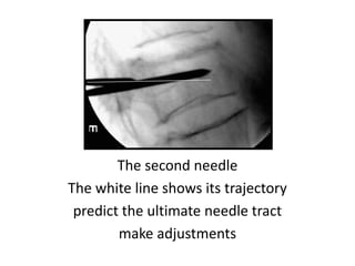 The second needle
The white line shows its trajectory
predict the ultimate needle tract
make adjustments
 