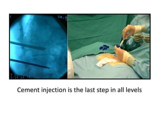 Cement injection is the last step in all levels
 
