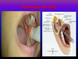 Techniques for local anasthesia in dentistry