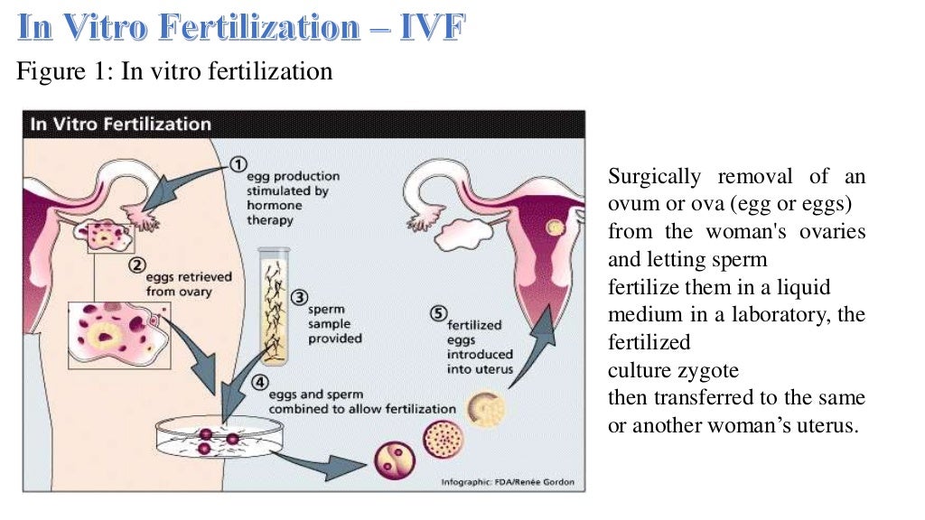 Techniques involved in assisted reproductive technology