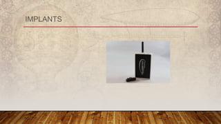 IMPLANTS
 