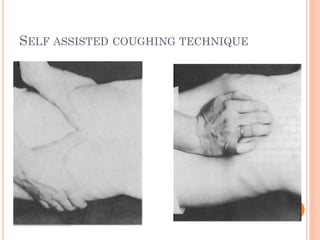 Techniques of chest physiotherapy | PPTX