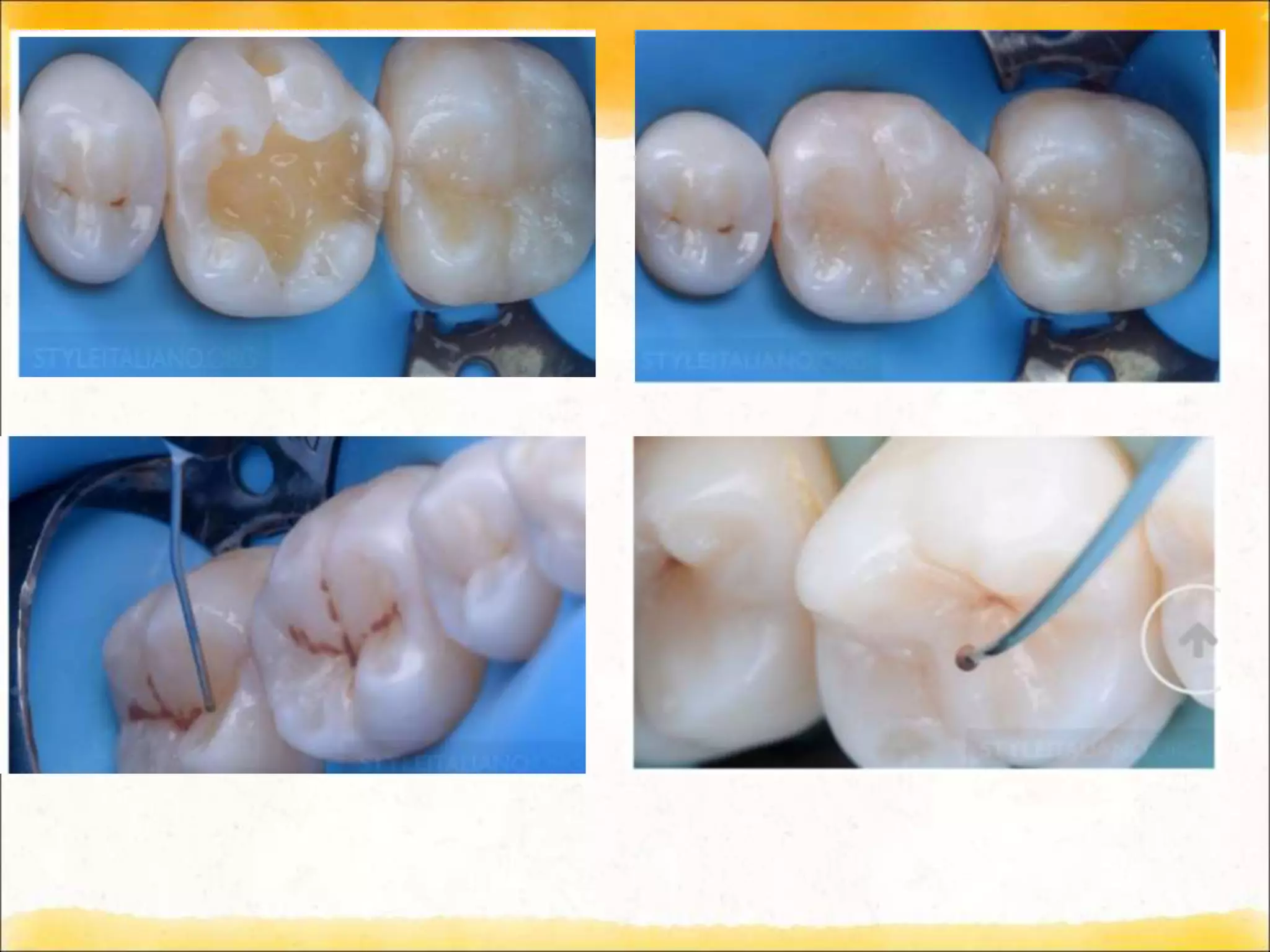 Techniques of direct composite restoration | PPT