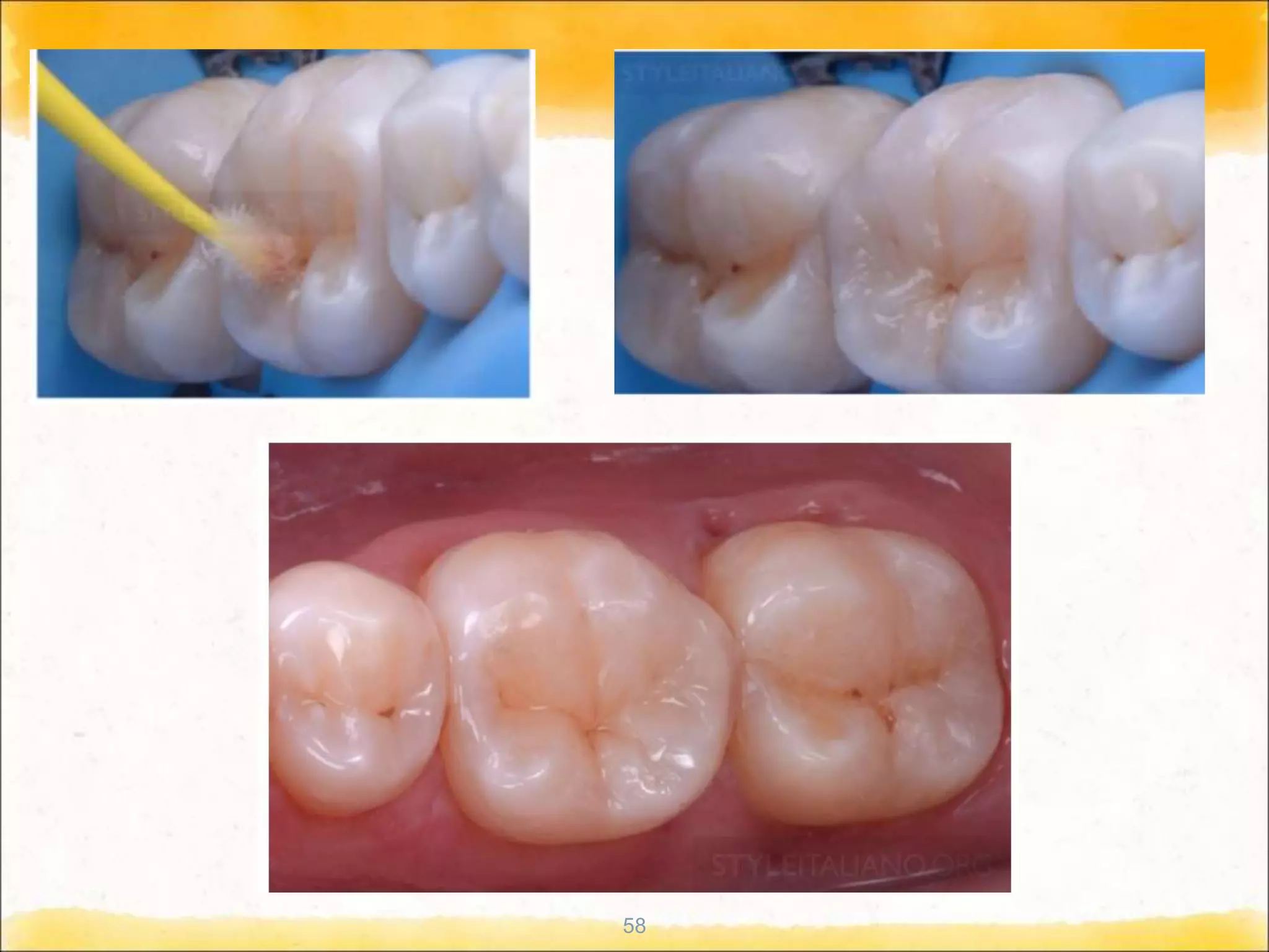 Techniques of direct composite restoration | PPT