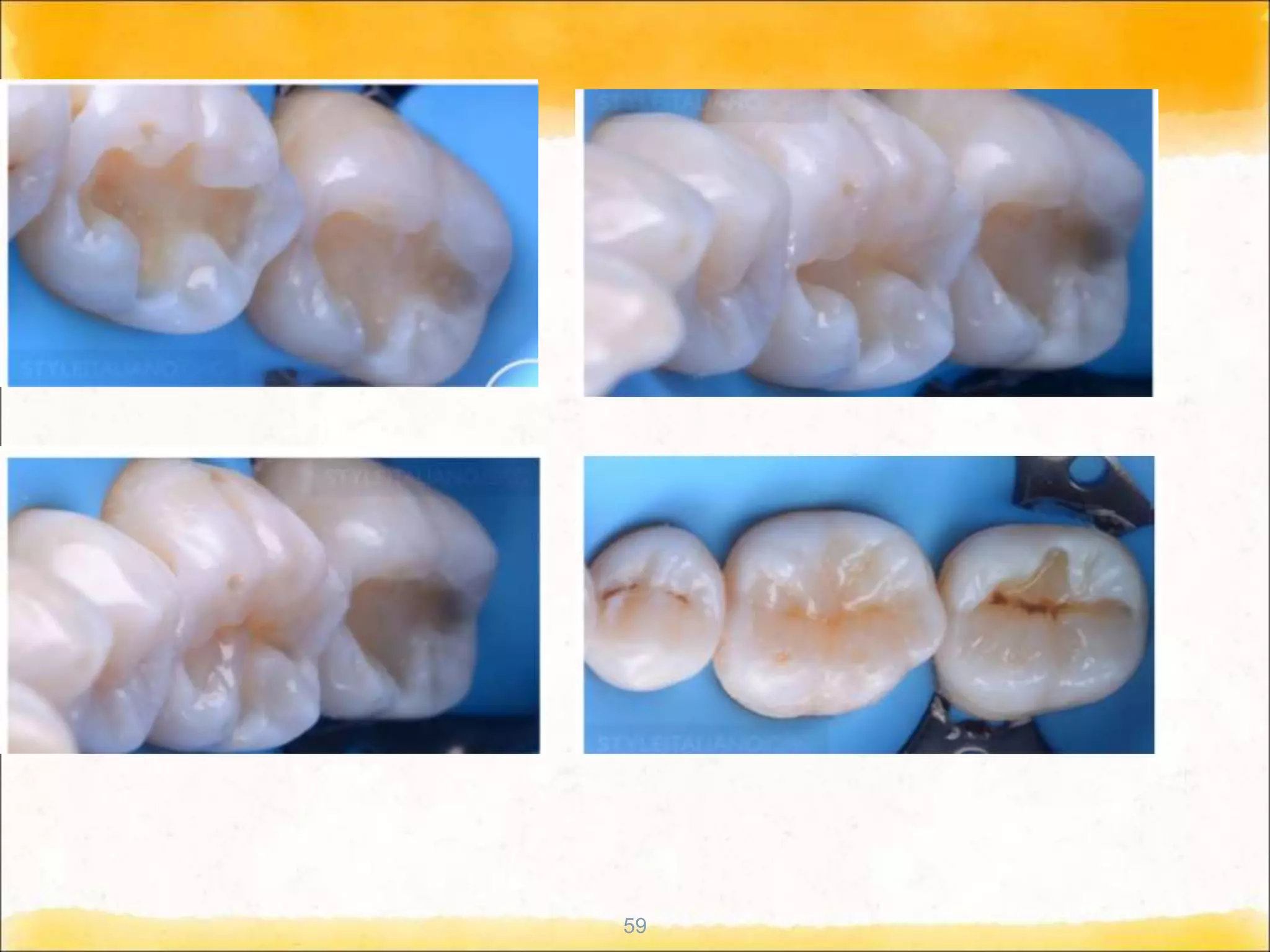 Techniques of direct composite restoration | PPT