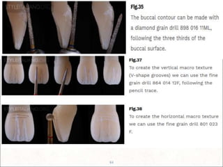 Techniques of direct composite restoration | PPT