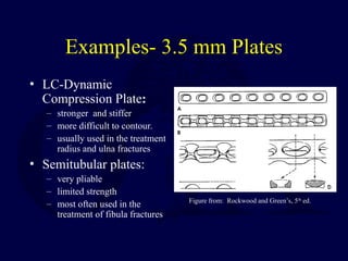basic methods of fracture fixation and stepwise approach | PPT