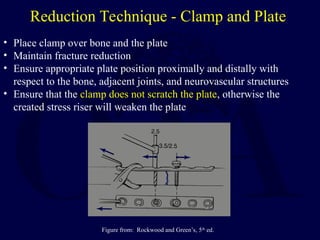 basic methods of fracture fixation and stepwise approach | PPT
