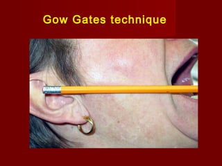 Gow Gates technique

 