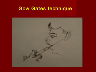 Gow Gates technique

 
