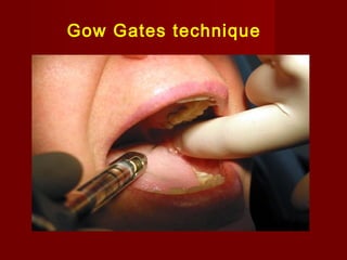 Gow Gates technique

 