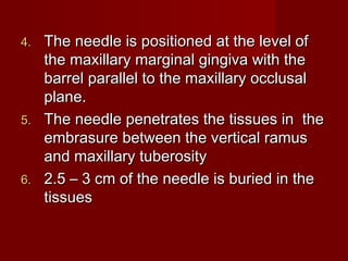 The needle is positioned at the level of
the maxillary marginal gingiva with the
barrel parallel to the maxillary occlusal
plane.
5. The needle penetrates the tissues in the
embrasure between the vertical ramus
and maxillary tuberosity
6. 2.5 – 3 cm of the needle is buried in the
tissues
4.

 