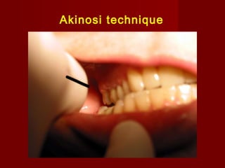Akinosi technique

 
