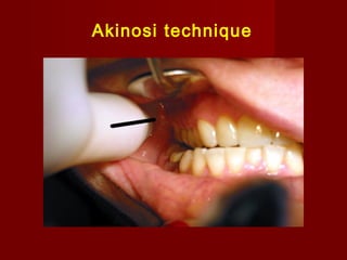 Akinosi technique

 