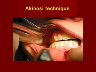 Akinosi technique

 