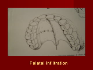 Palatal infiltration

 