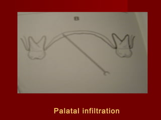 Palatal infiltration

 