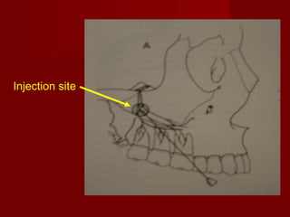Injection site

 