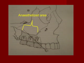Anaesthetized area

 